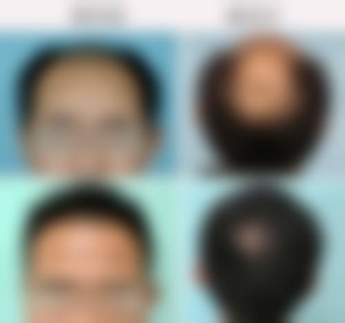 四、贵阳丽都毛发移植中 心特色项目