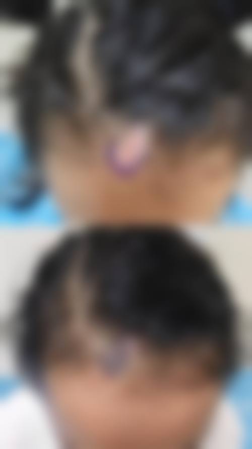 四、广州穗雅医院植发科特色项目