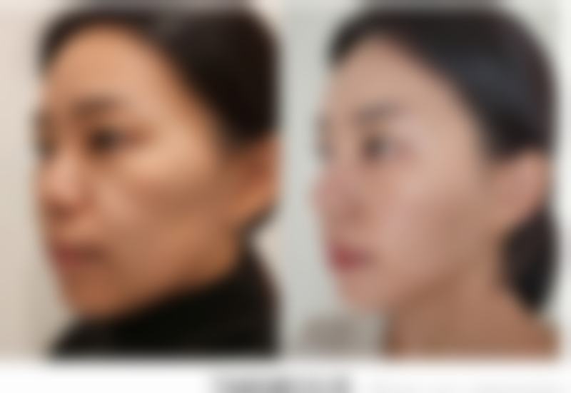 四、线提升隆鼻与手术隆鼻的对比