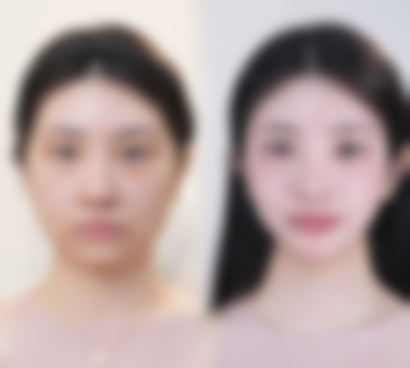 六、线提升隆鼻成效的个体差异