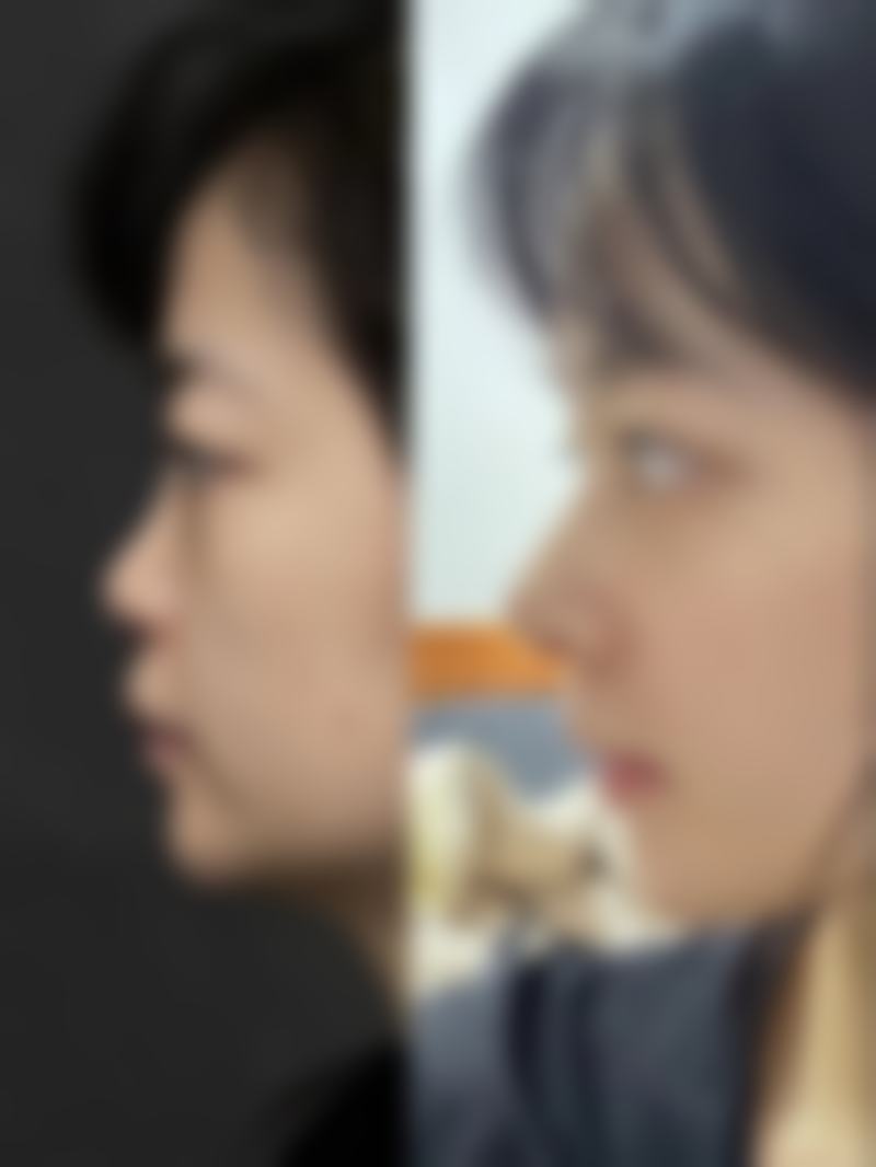 六、喝牛奶在疤痕增生手术后的作用及注意事项