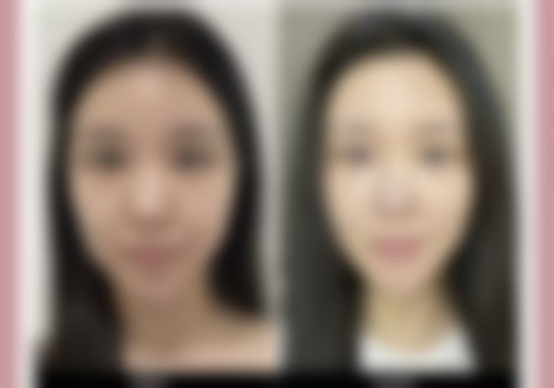 线雕隆鼻什么意思？全面揭秘微创隆鼻方式、适用人群、效果及风险 