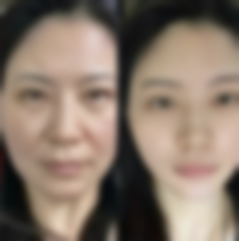 七、理性看待超声炮改善眼袋