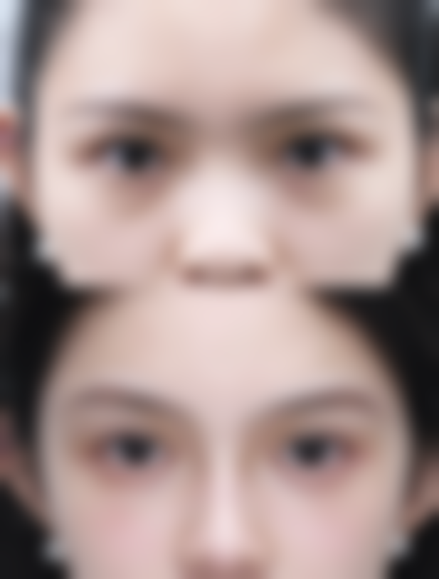 二、影响新生儿什么时候变双眼皮的因素