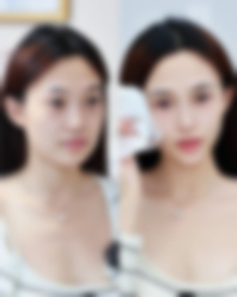 三、线提升隆鼻的适合人群与局限性