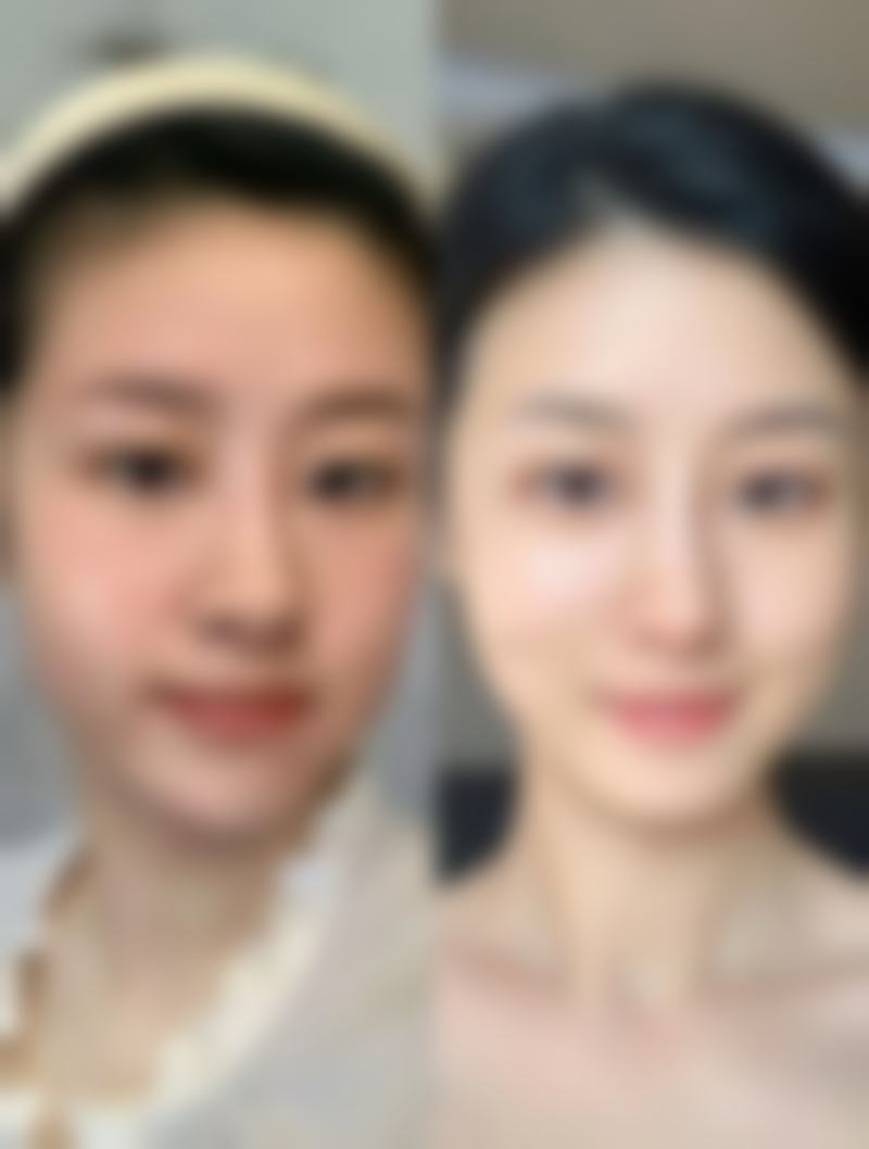 三、去眼袋手术术后保护与风险控制