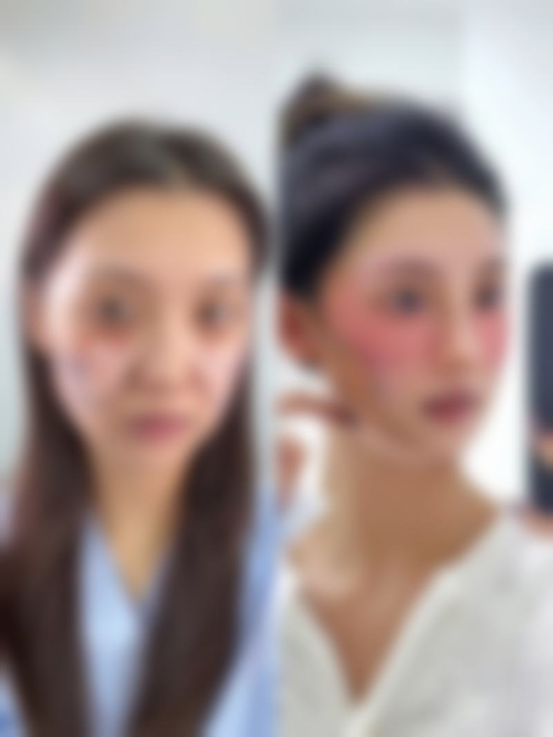 三、土豆片对眼袋真正的作用成效