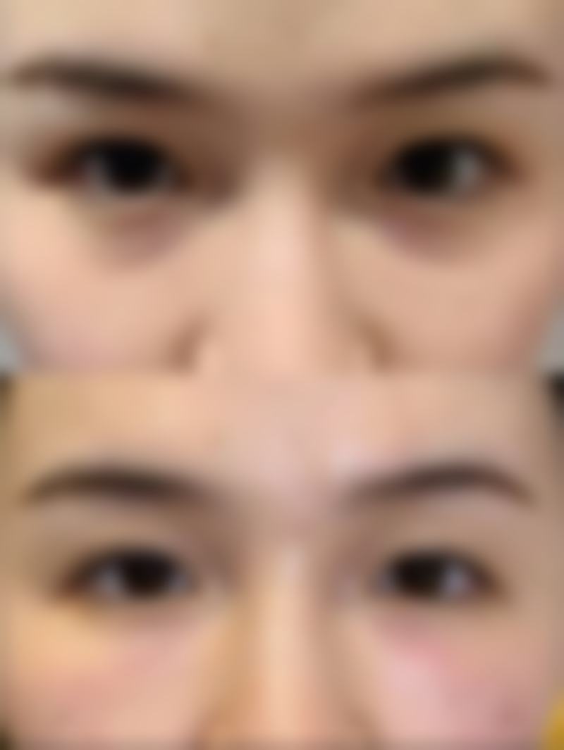 七、吸脂减肥的注意事项