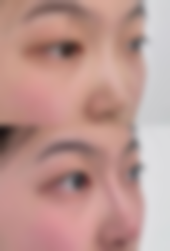 四、全切双眼皮渗血的风险提示