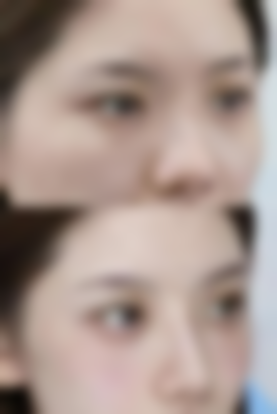 二、眼袋分型与对应祛除手段