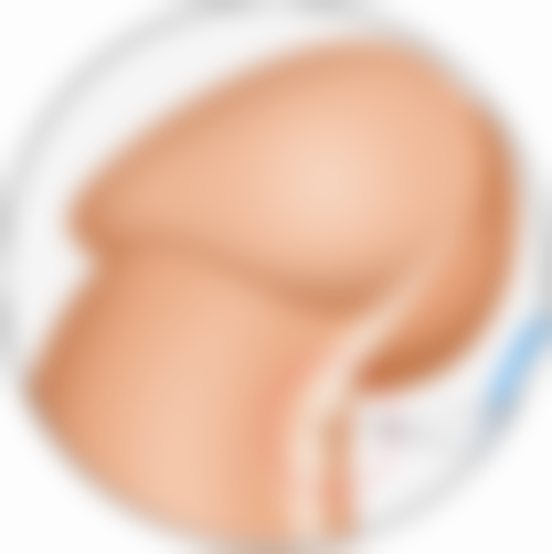 一、埋线双眼皮一大一小正常吗