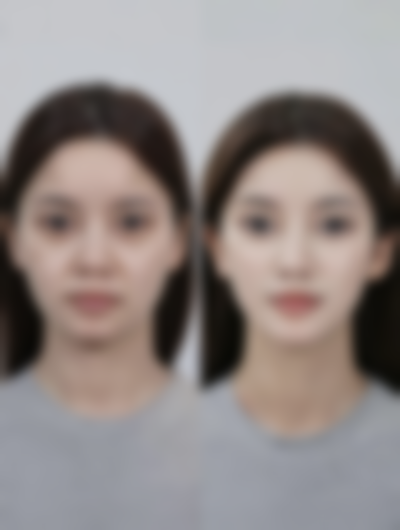 打完瘦脸针能躺着吗？了解不同时间段躺卧影响及注意事项，助你安全变美 