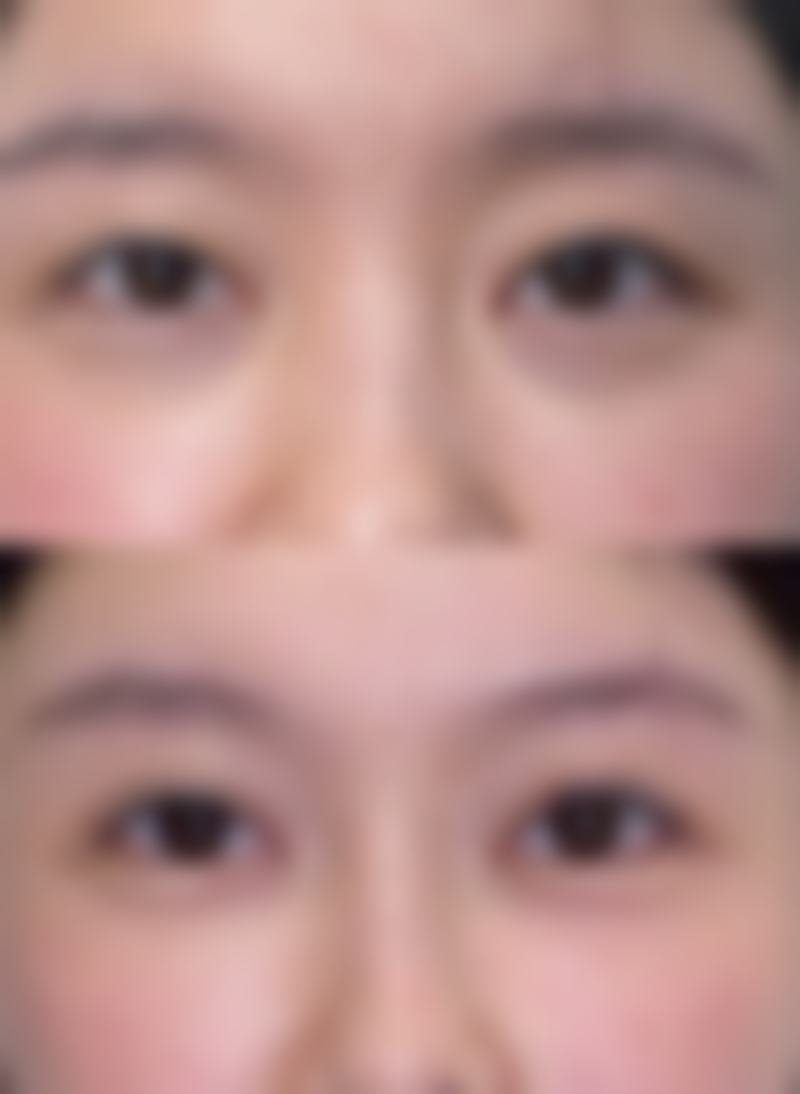 三、适用人群分析：膨体和异体骨隆鼻适合谁