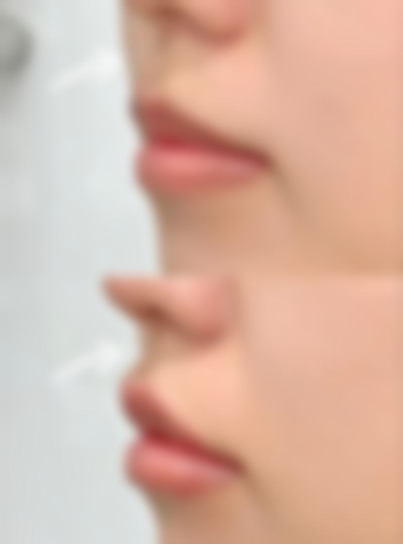 二、埋线双眼皮一大一小的原因分析