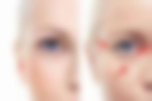 怎么去除痘痘不留疤痕？分阶段处理+科学护理+医美方案助你告别痘疤困扰