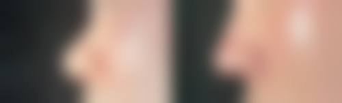 一、打瘦脸针的原理及基本情况