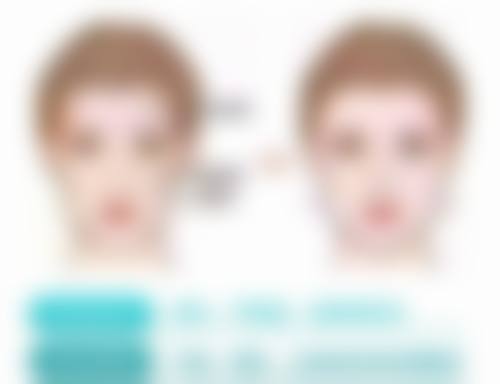 一、割双眼皮三个月为何不建议修复