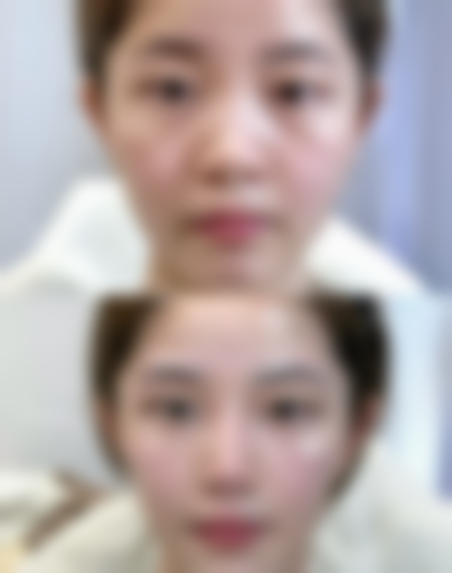 三、术后修复的注意事项