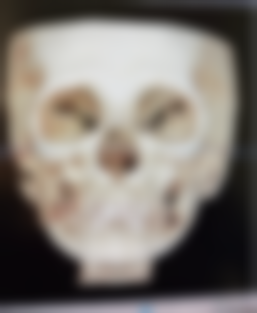 五、不适宜打瘦脸针的人群