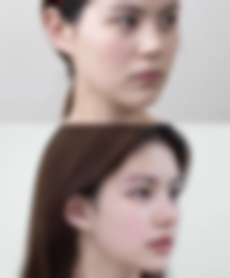 三、割双眼皮怎么割的：常见手术方式