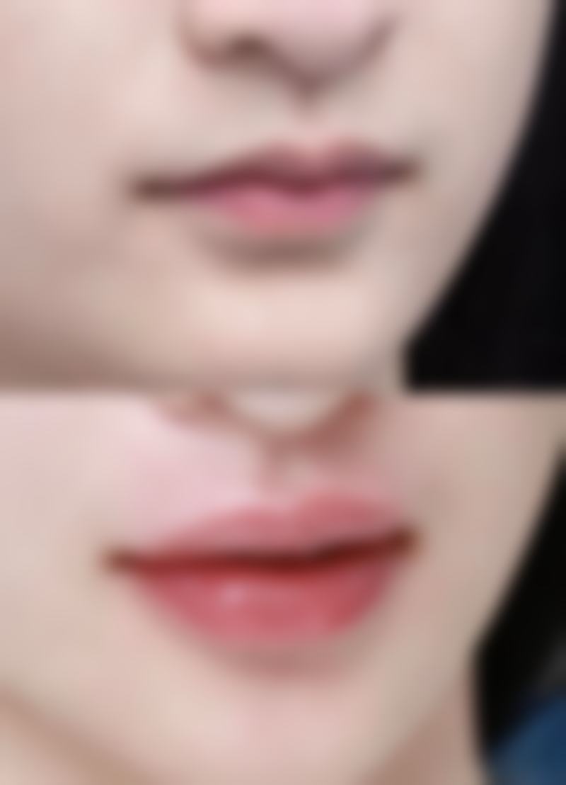 一、水痘疤痕的类型及成因