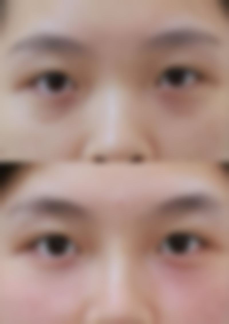 如何能修复疤痕增生？药物、激光、手术等多种方法为你重塑光滑肌肤