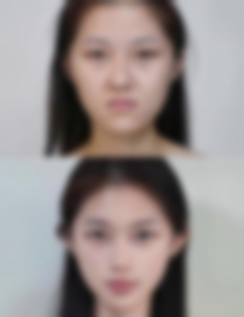 四、割双眼皮三个月现阶段护理建议