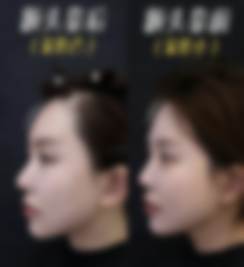 六、打瘦脸针前的准备工作