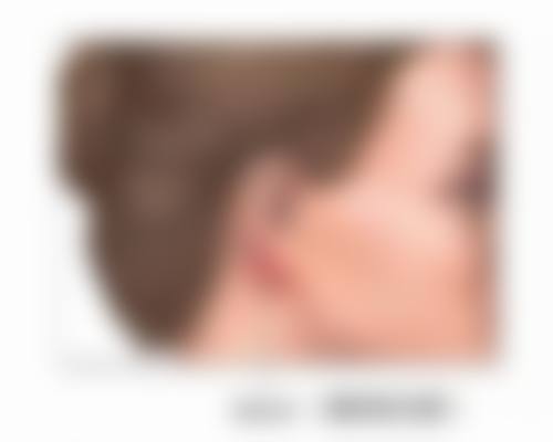 四、内取眼袋修复过程中的美学提示