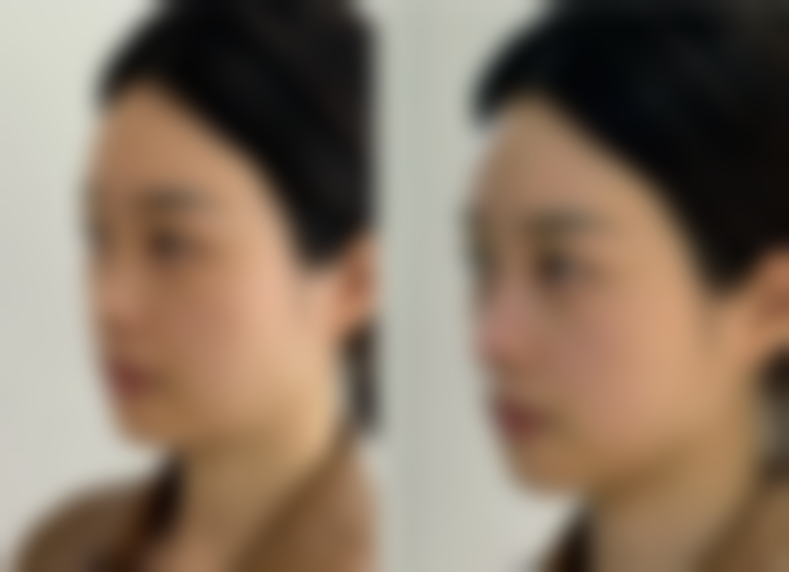 四、总结：有不开刀不手术的双眼皮吗？