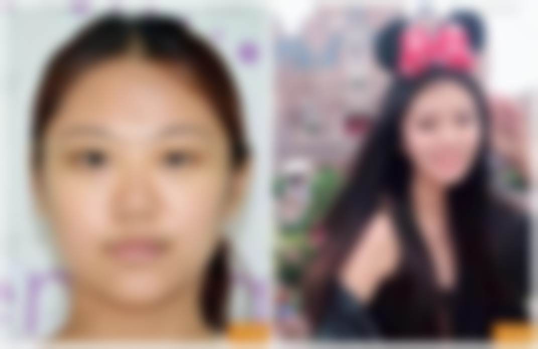 五、北京禾美嘉贺天遥医生隆胸修复的成功实例分享