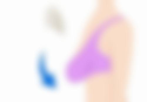 一、双眼皮疤痕消失时间的大致范围