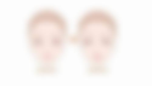 三、下颌缘吸脂的过程和注意事项