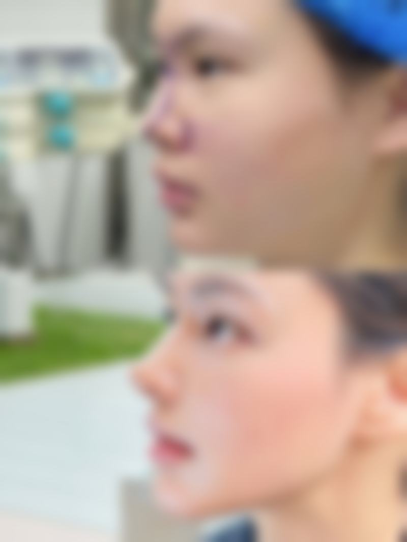 四、下颌缘吸脂的风险和成效