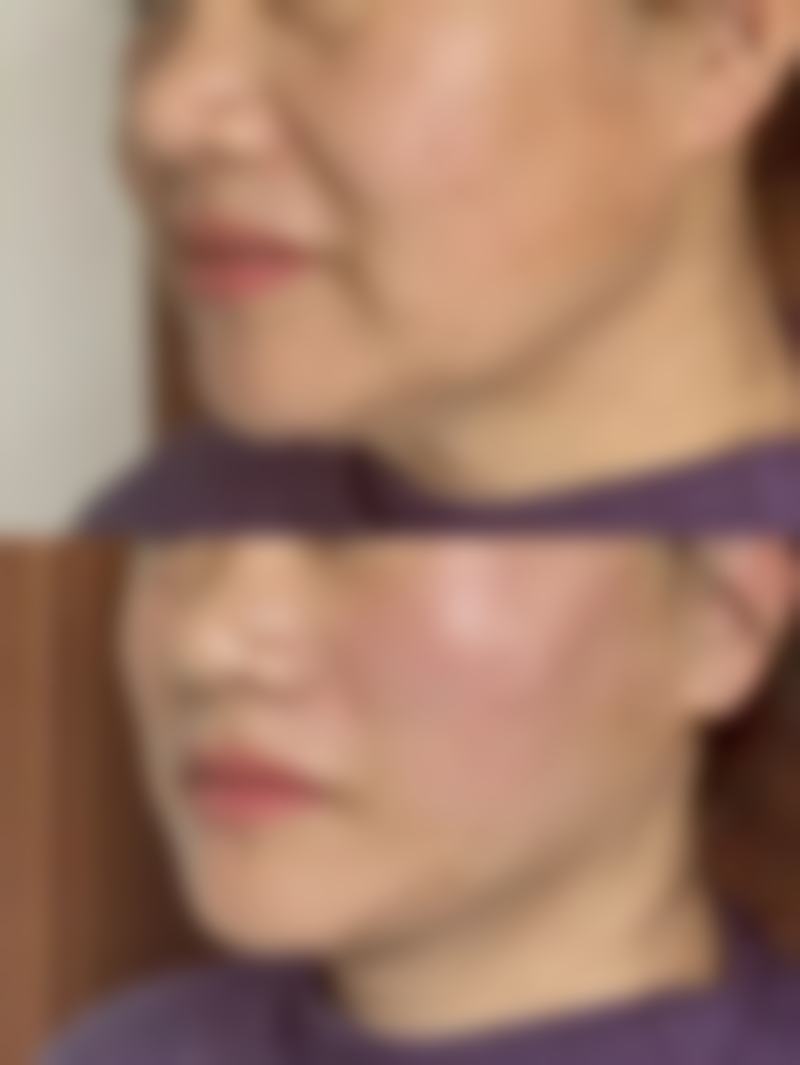 一、凹眼睛与双眼皮手术的基本认知