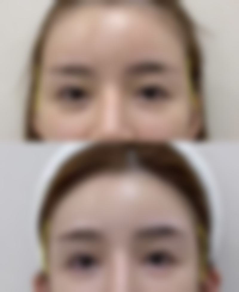 四、打完瘦脸针后笑起来僵硬的修复情况