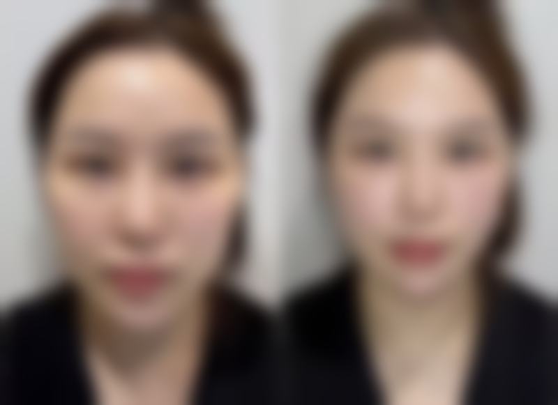 双眼皮三个月可以修复吗？了解修复时机、风险及护理要点很重要！ 