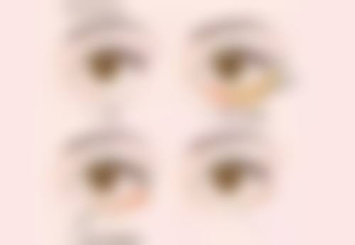 三、肿眼泡双眼皮的手术修复方法