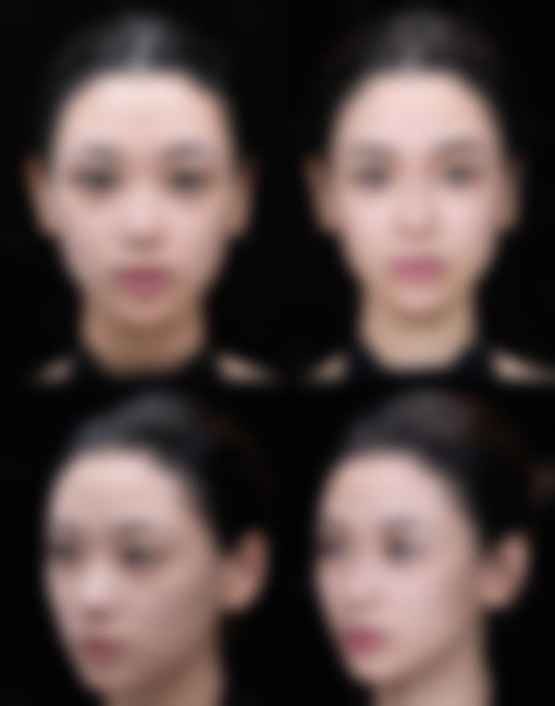 五、肿眼泡双眼皮修复医生推荐