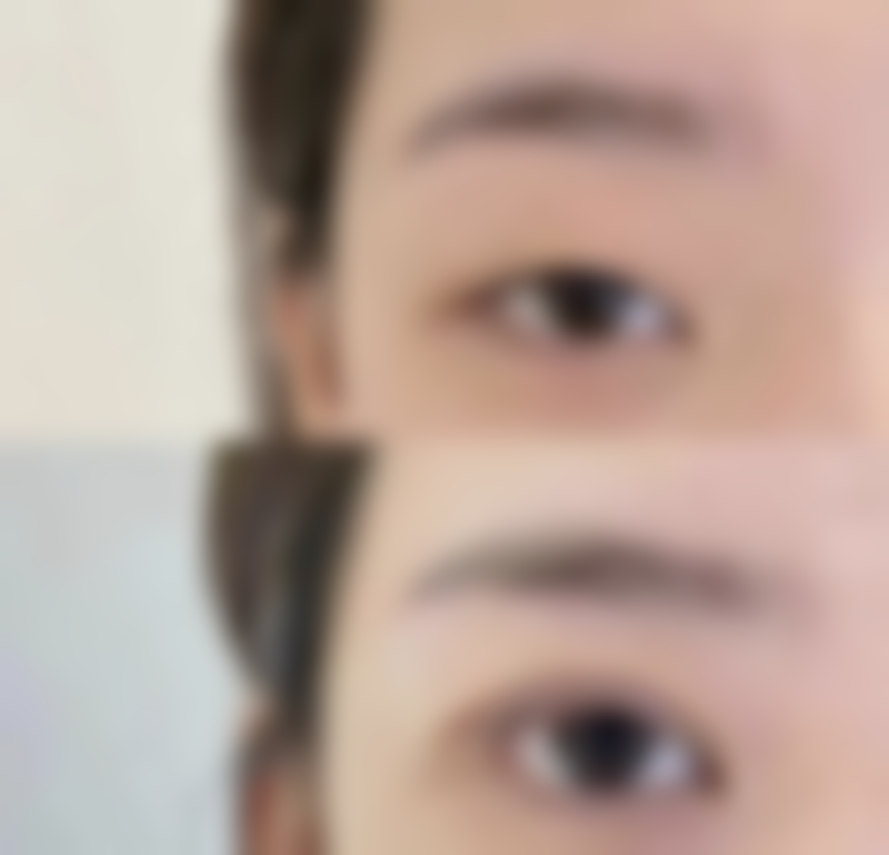 一、甲状腺疤痕评估方向