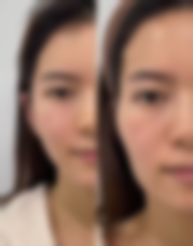 二、眼袋做了手术还会长吗？