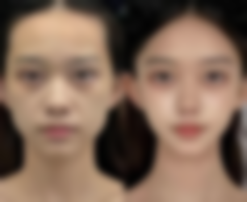 全切双眼皮变成多眼皮怎么办？了解原因与改善方法，还知晓二次修复时间 