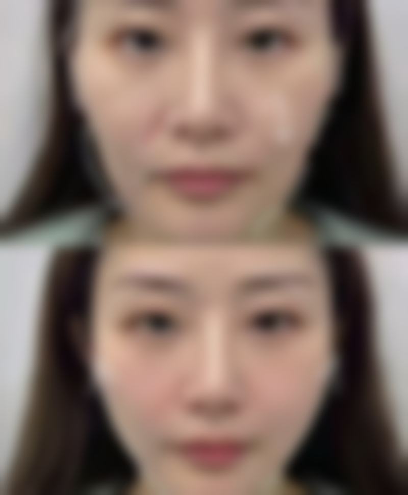 二、日常护理去除轻微下眼袋