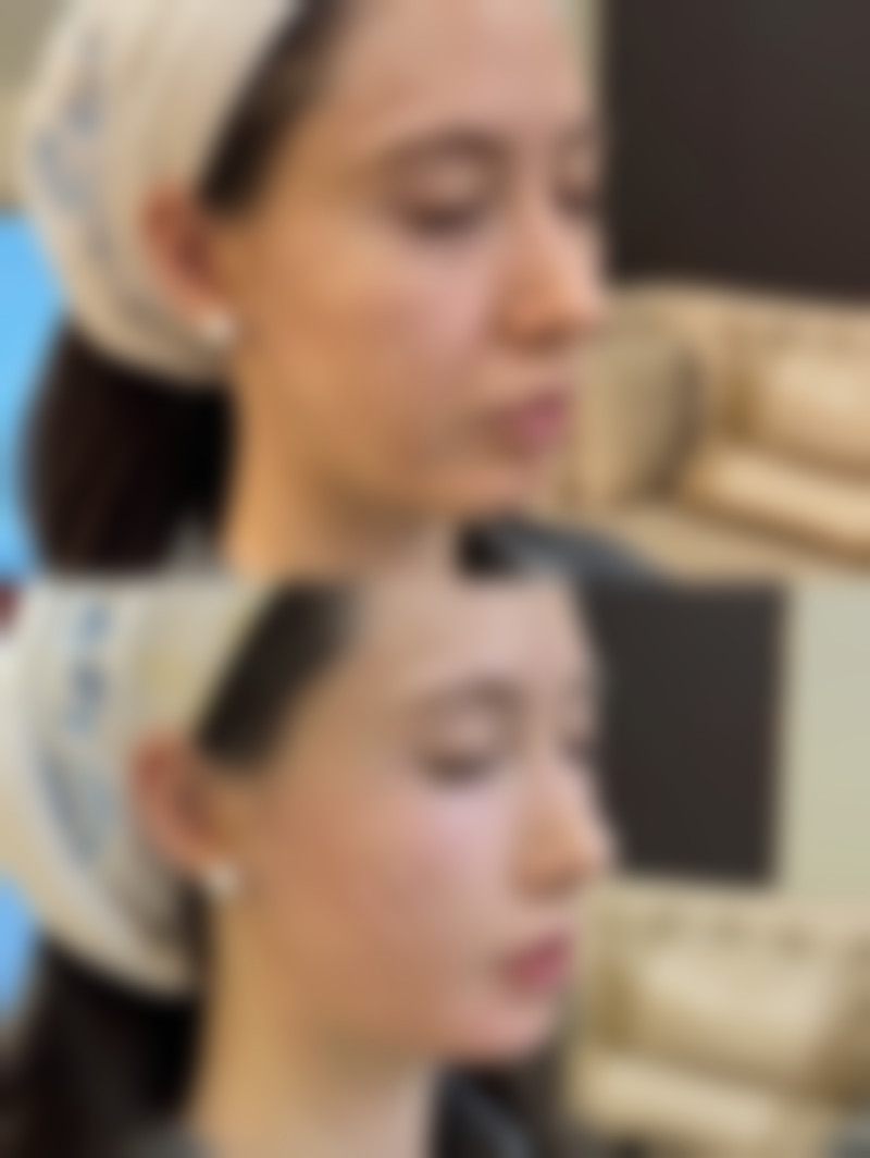 一、四十岁做双眼皮的可行性