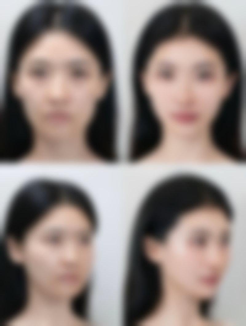 一、疤痕增生与疤痕体质的基本概念