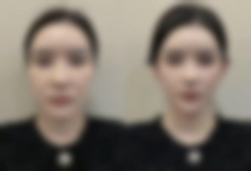 六、去眼袋后有疤痕，心态特别重要