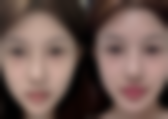 四、去眼袋后有疤痕，修复时间及注意事项