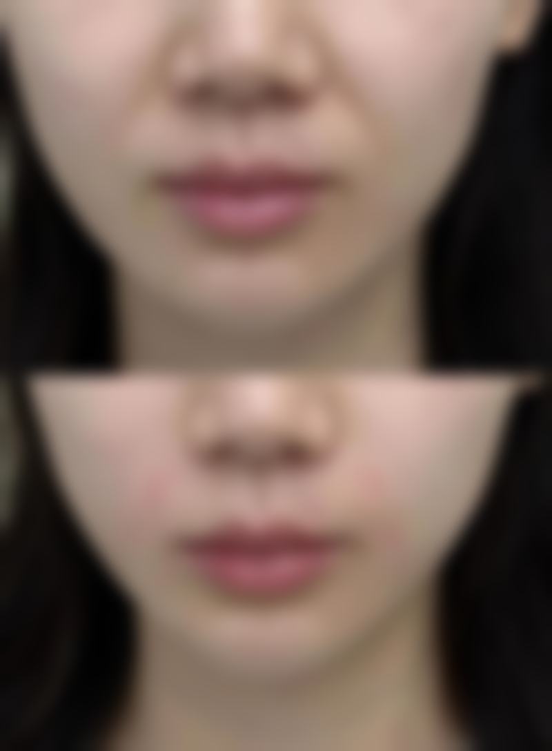 二、常见除皱美容仪类型及抗皱原理