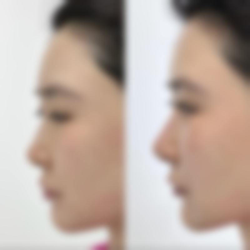 溶脂和抽脂有什么区别呢？适用人群、效果、风险大不同，一文帮你了解 