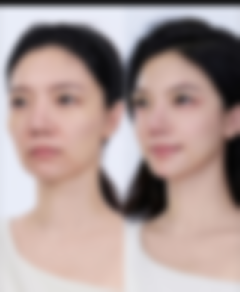 隆鼻要多久可以做修复手术？综合多因素，6个月至1年后修复更稳妥 